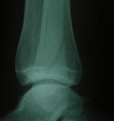 Fibular